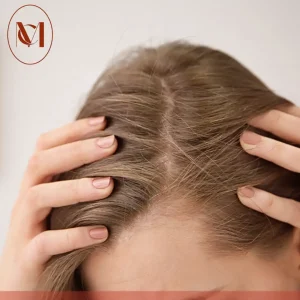 القضاء على فطريات الشعر