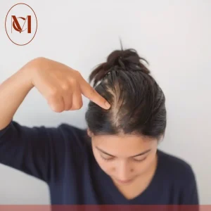 تقوية بصيلات الشعر